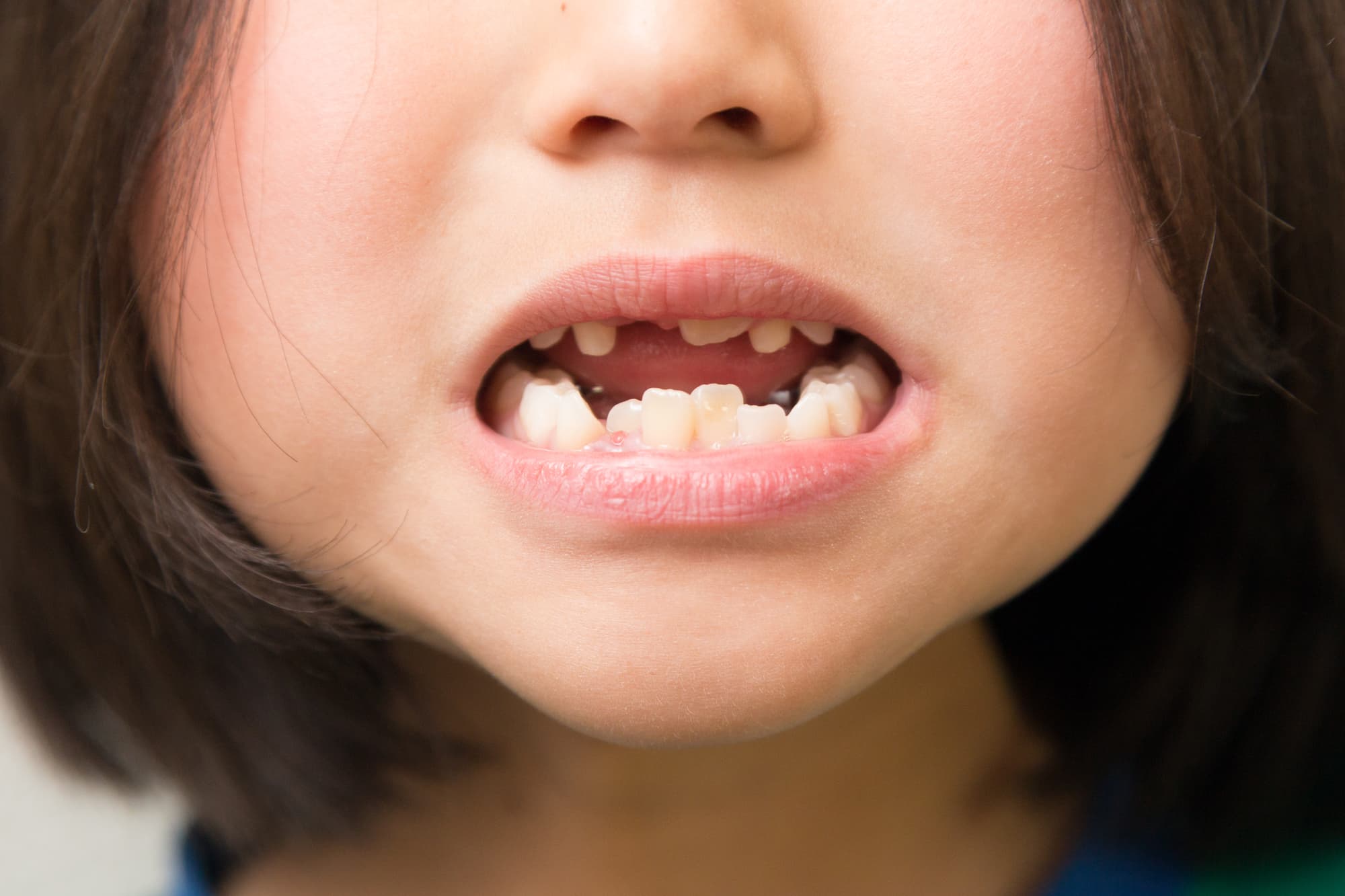 歯並びが悪い子供の口元
