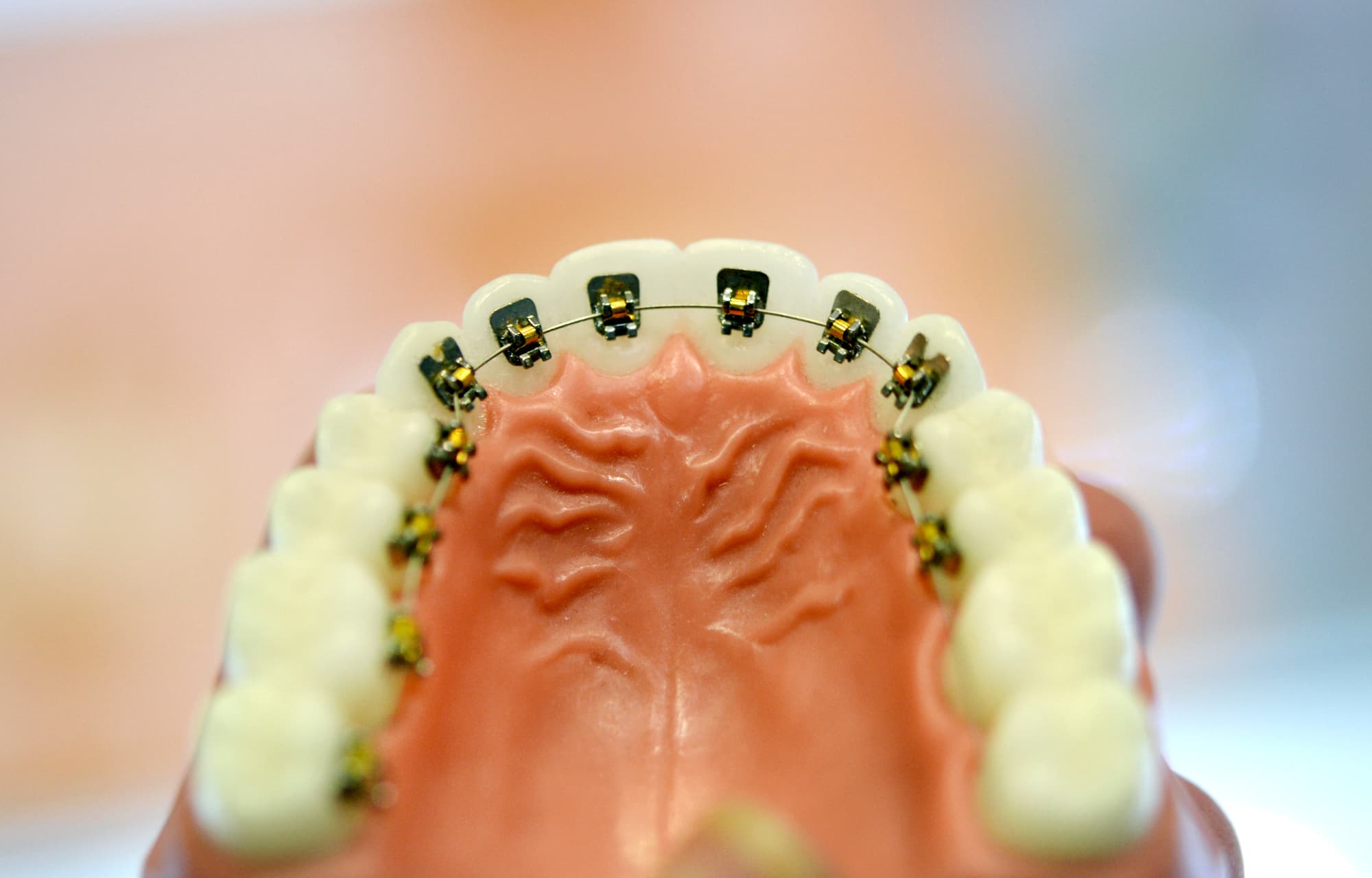 裏側矯正の模型