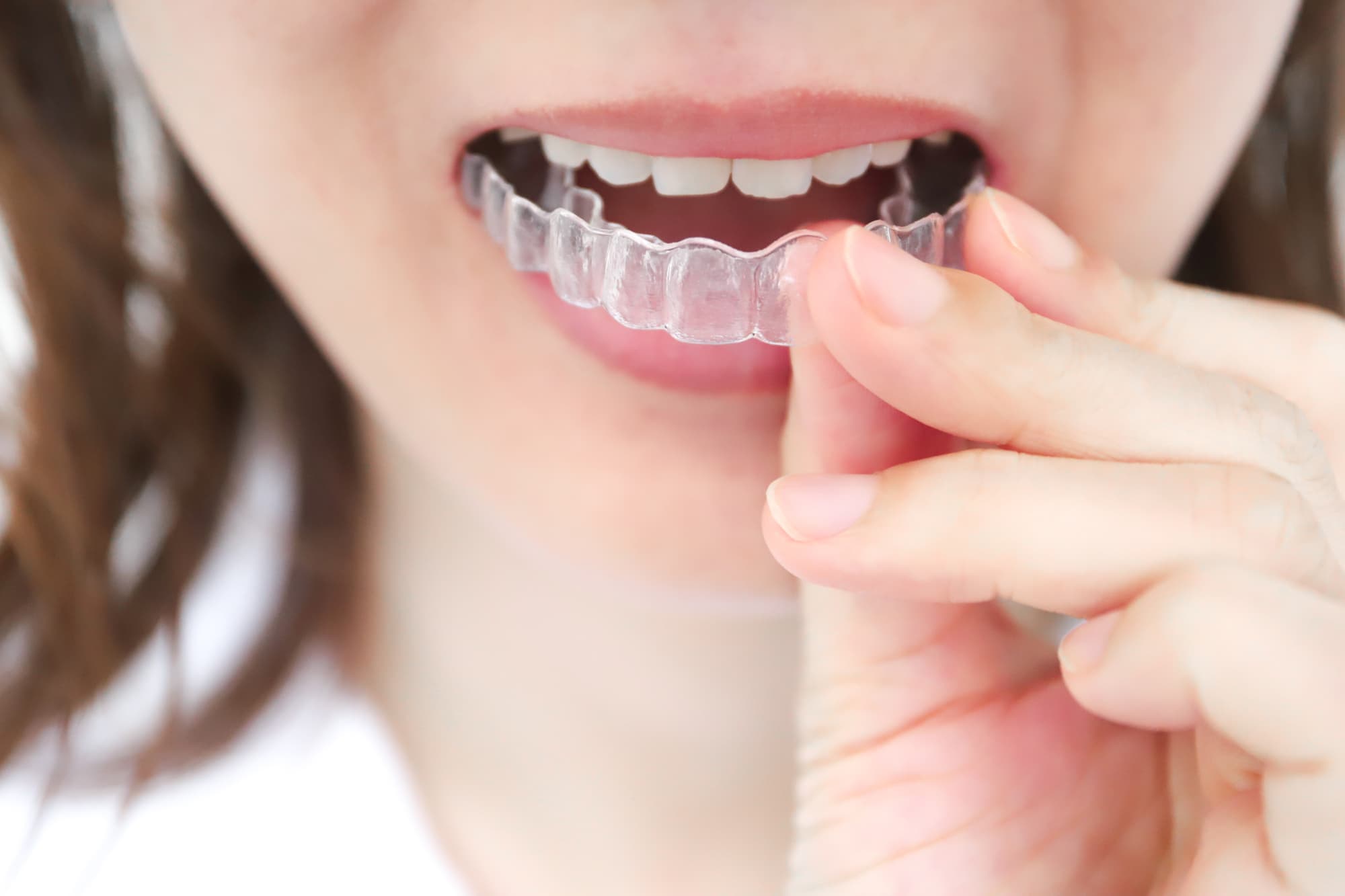 スプリント療法で顎関節症の治療をする様子